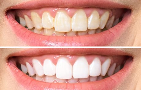 הלבנת שיניים: 4 מיתוסים שכדאי שתפסיקו להאמין בהם