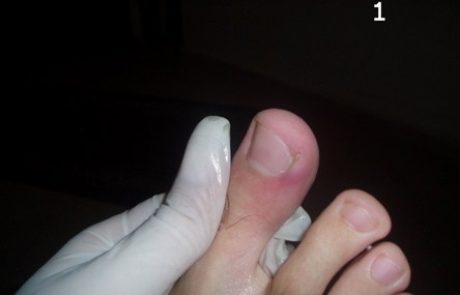 טיפול בחודרנית – צעד אחר צעד