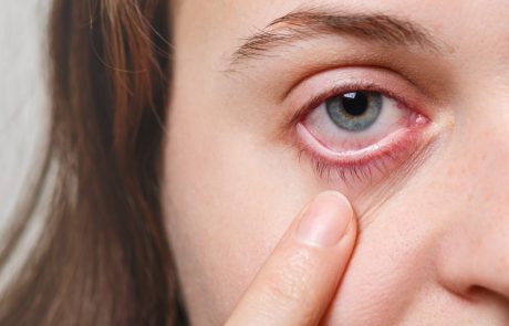 עיניים מגרדות עיניים צורבות עיניים אדומות