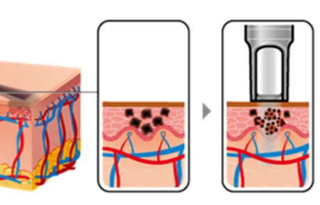 מתחרטים על קעקועים בגופכם?