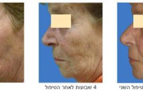 הדור האחרון באבולוציית מערכות חידוש העור