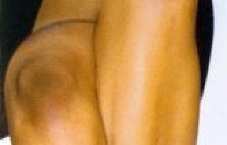 לטפל במרפקים ובברכיים