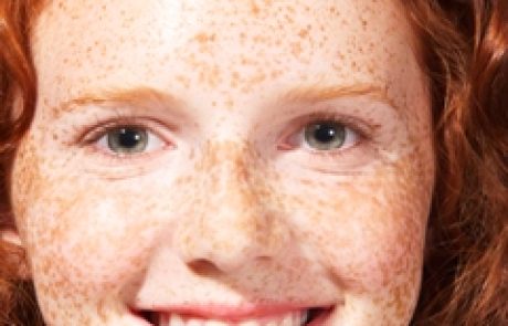 הכל אודות נקודות חן ופיגמנטציה בעור