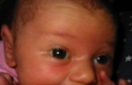 ניתוחי שדיים והנקה