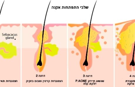 הקרב על הטיפול באקנה