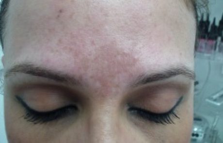 קוסמטיקה: איך ניתן לטשטש כתמים בעור