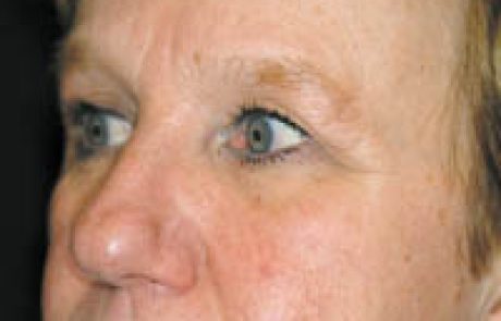 להבהיר את העור