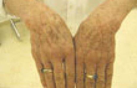 חידוש עור הפנים