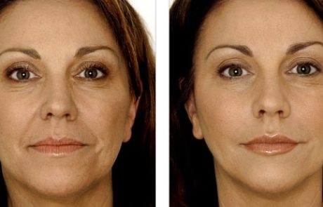 מילוי קמטים ללא הזרקה