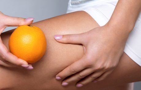 נא להכיר: צלוליט