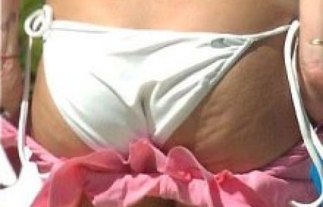 מתכון לטיפול בצלוליט