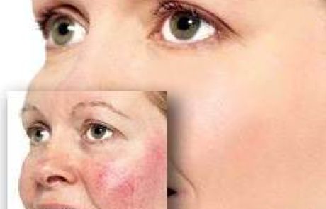 קוסמטיקה: הטיפול ברוזציאה