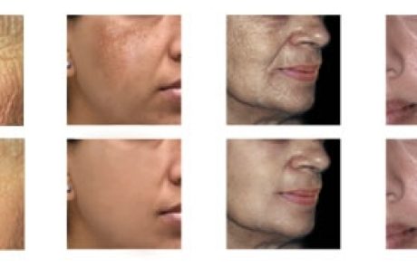 מזותראפיה ועט הפלא