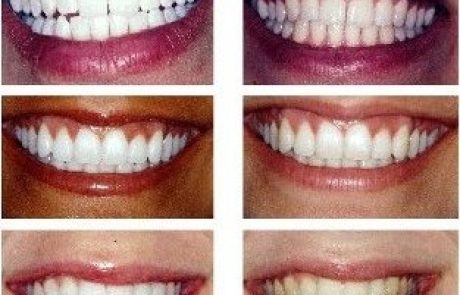 הלבנת שיניים