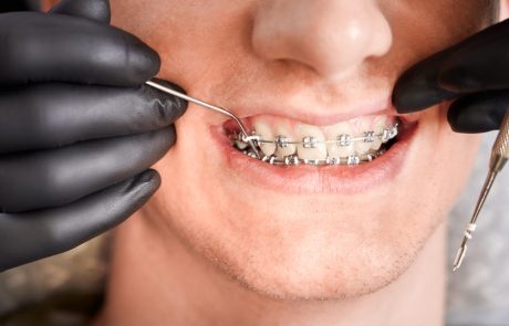יישור שיניים בשיטת אינויזיליין – מרפאת שיניים ד"ר שטיימן