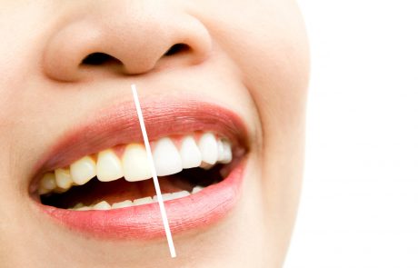 היתרונות של השתלות שיניים ממוחשבות