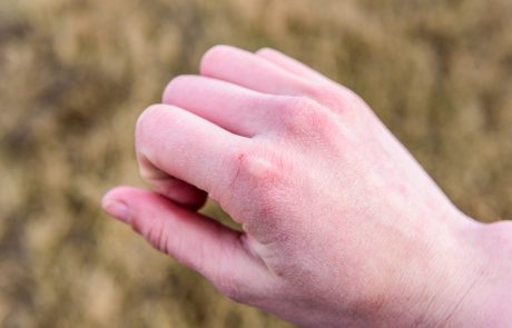 שימי ידך – טיפול בידיים חיוני מגיל צעיר